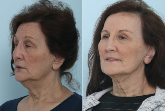 Juvederm Injectable Gel Before and After Photos in Houston, TX, Patient 9453