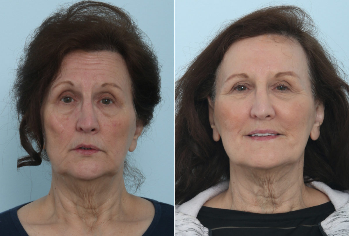 Juvederm Injectable Gel Before and After Photos in Houston, TX, Patient 9453