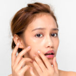 What Causes Acne Breakouts?