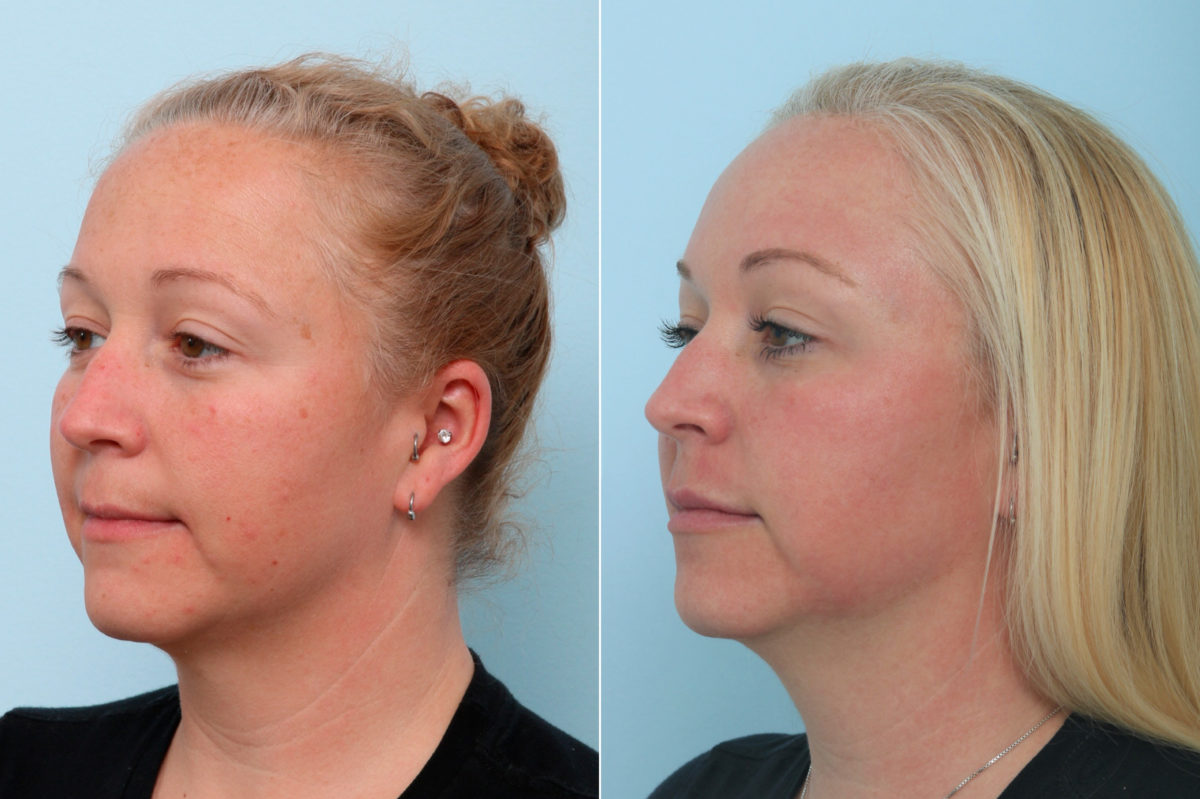 Fraxel Laser Before and After Photos in Houston, TX, Patient 9770