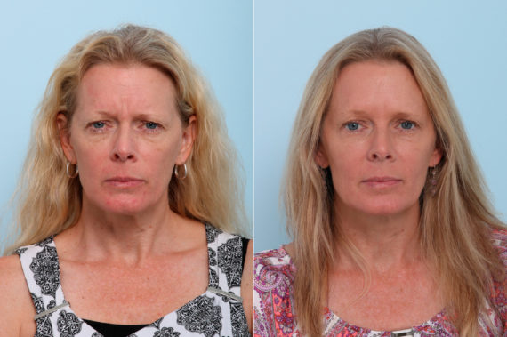Botox® Cosmetic Before and After Photos in Houston, TX, Patient 7750