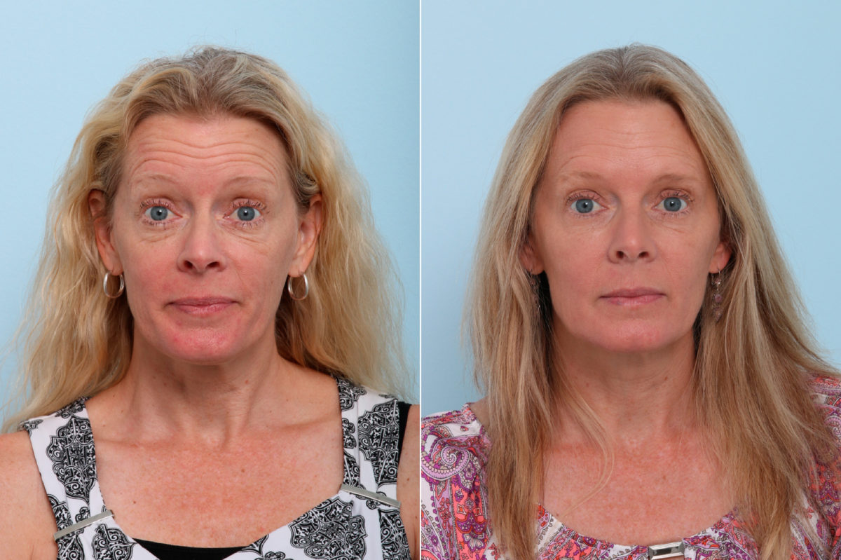 Botox® Cosmetic & Xeomin Before and After Photos in Houston, TX, Patient 7750