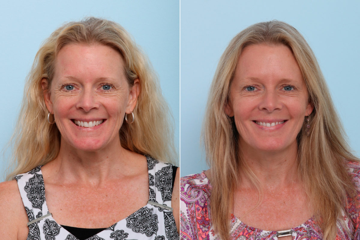 Botox® Cosmetic Before and After Photos in Houston, TX, Patient 7750