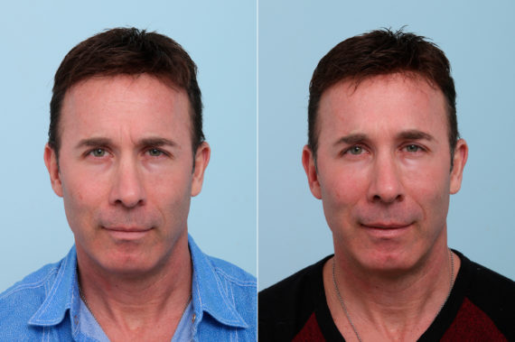 Botox® Cosmetic & Xeomin Before and After Photos in Houston, TX, Patient 7757