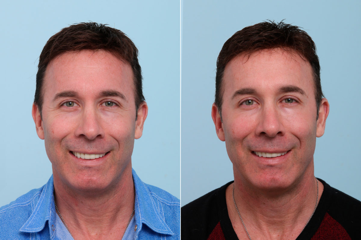 Botox® Cosmetic Before and After Photos in Houston, TX, Patient 7757