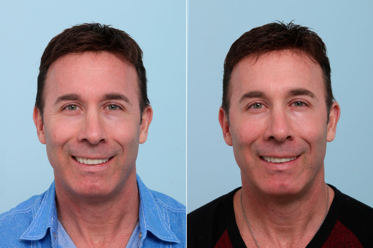 Botox® Cosmetic & Xeomin Before and After Photos in Houston, TX, Patient 7757