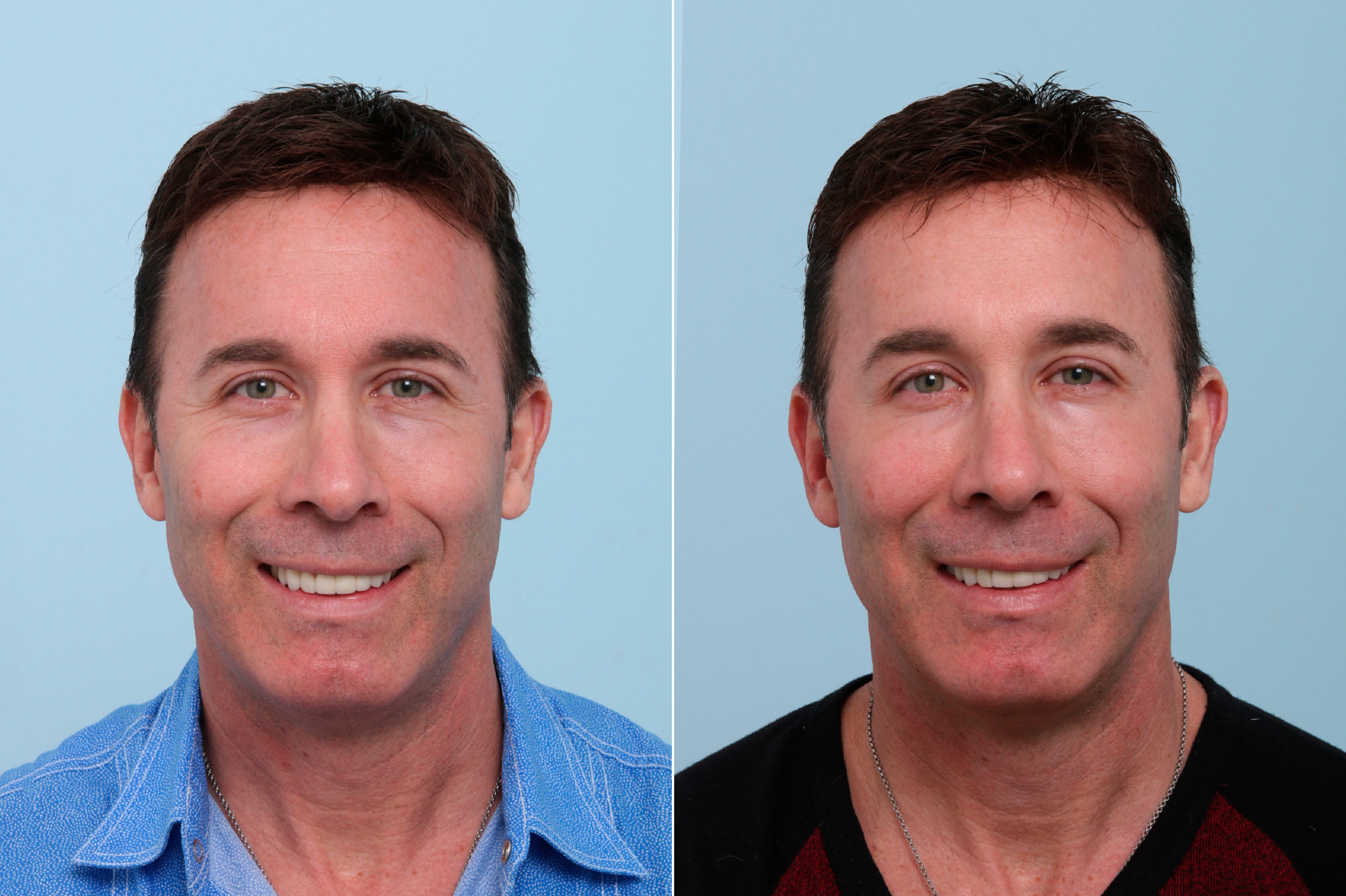 Botox® Cosmetic Photos Houston Tx Patient 7757