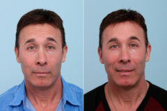 Botox® Cosmetic Before and After Photos in Houston, TX, Patient 7757