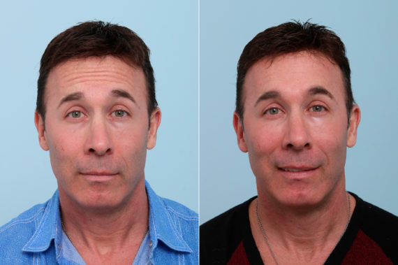 Botox® Cosmetic & Xeomin Before and After Photos in Houston, TX, Patient 7757