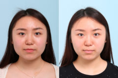 Botox® Cosmetic Before and After Photos in Houston, TX, Patient 7764