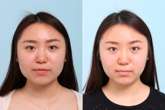 Botox® Cosmetic Before and After Photos in Houston, TX, Patient 7764