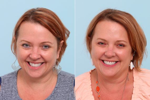 Botox® Cosmetic Before and After Photos in Houston, TX, Patient 7767