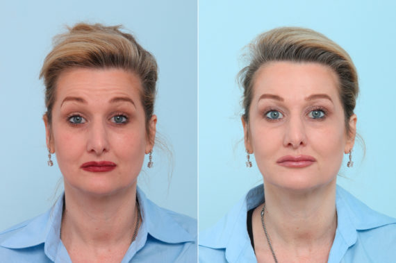 Botox® Cosmetic Before and After Photos in Houston, TX, Patient 7770
