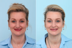 Botox® Cosmetic Before and After Photos in Houston, TX, Patient 7770