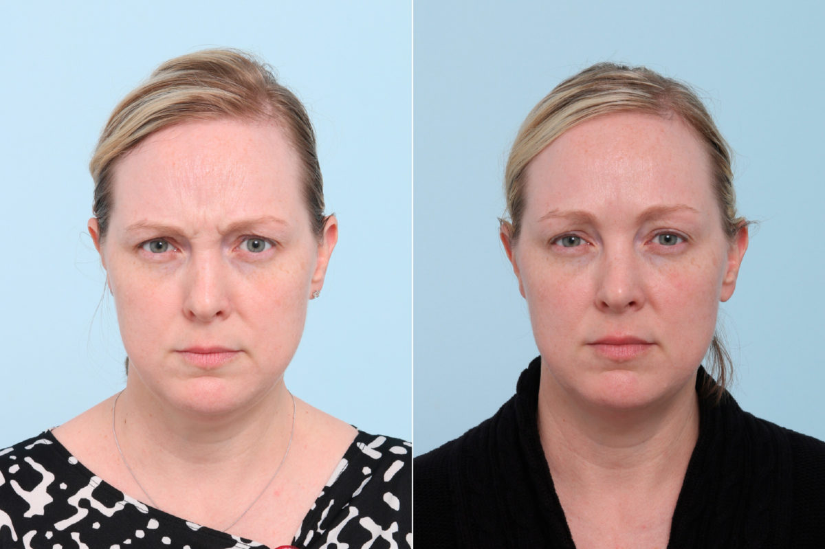 Botox® Cosmetic & Xeomin Before and After Photos in Houston, TX, Patient 7775