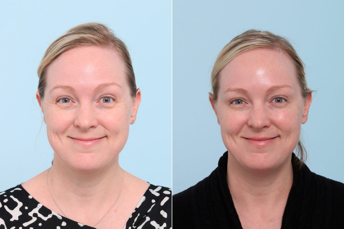 Botox® Cosmetic Before and After Photos in Houston, TX, Patient 7775