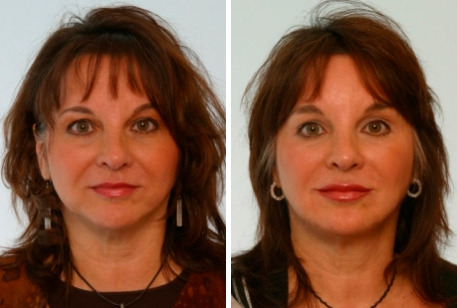Fillers Before and After Photos in Houston, TX, Patient 7895
