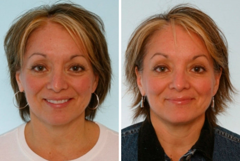 Fillers Before and After Photos in Houston, TX, Patient 7918