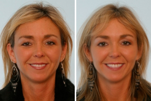 Fillers Before and After Photos in Houston, TX, Patient 7933