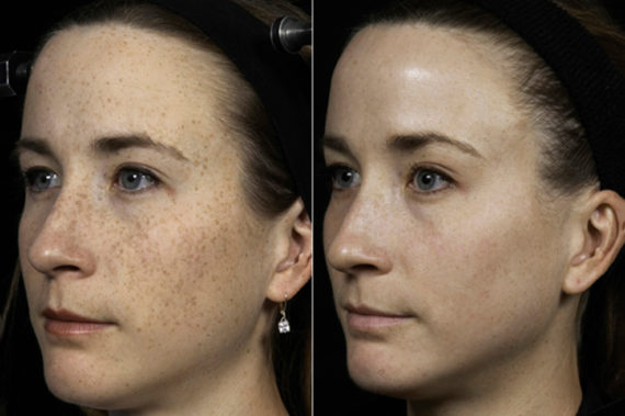 Fraxel Laser Before and After Photos in Houston, TX