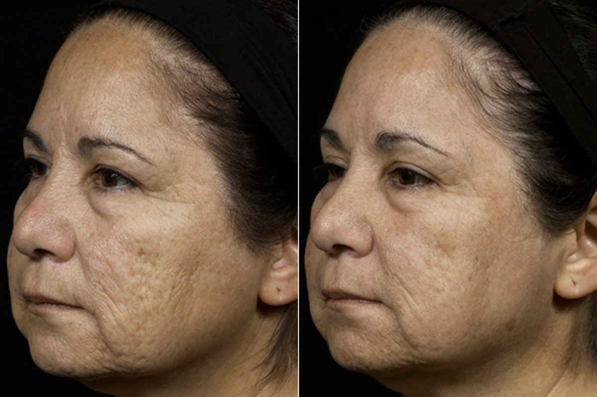 Fraxel Laser Before and After Photos in Houston, TX, Patient 7962