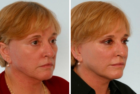 Radiesse Before and After Photos in Houston, TX, Patient 8114