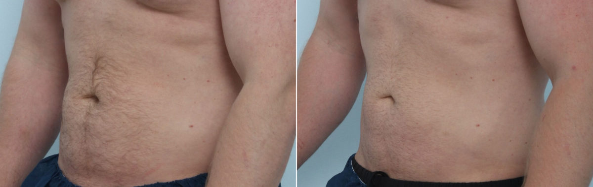 CoolSculpting Before and After Photos in Houston, TX, Patient 9790