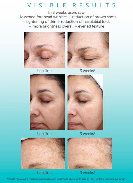 Patients can expect to see the results from their microneedling with FactorFive session in only a few days, as the cellular production steadily increases.
