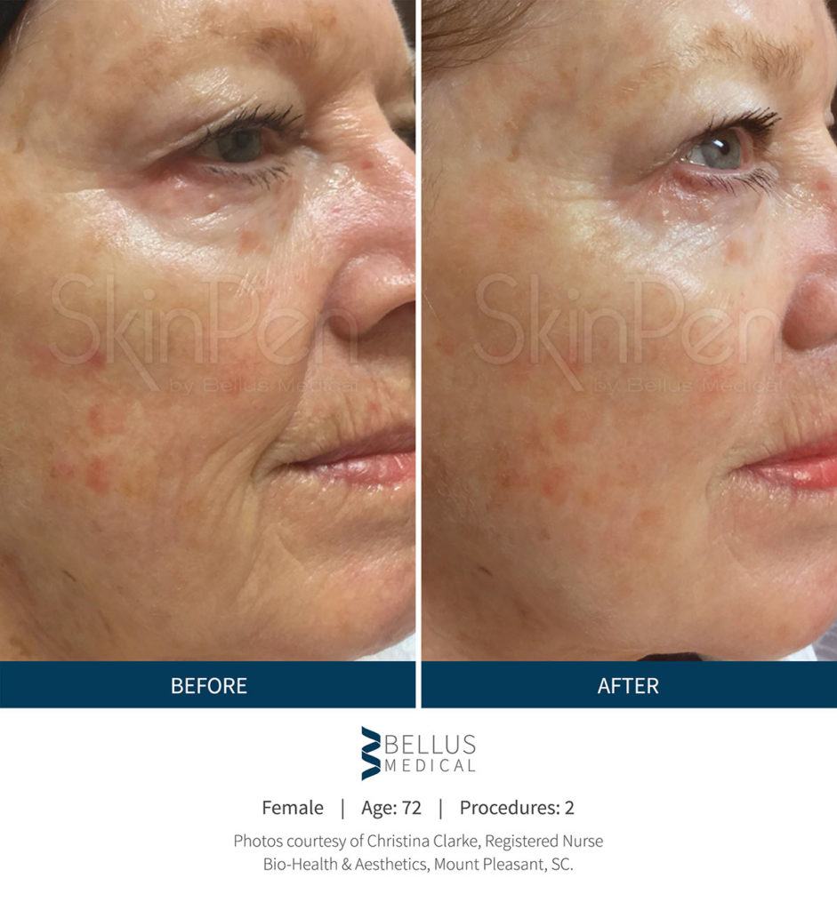 Before and after gallery of SkinPen in Houston, TX. Mirror Mirror Beauty Boutique by Dr. Paul Vitenas.
