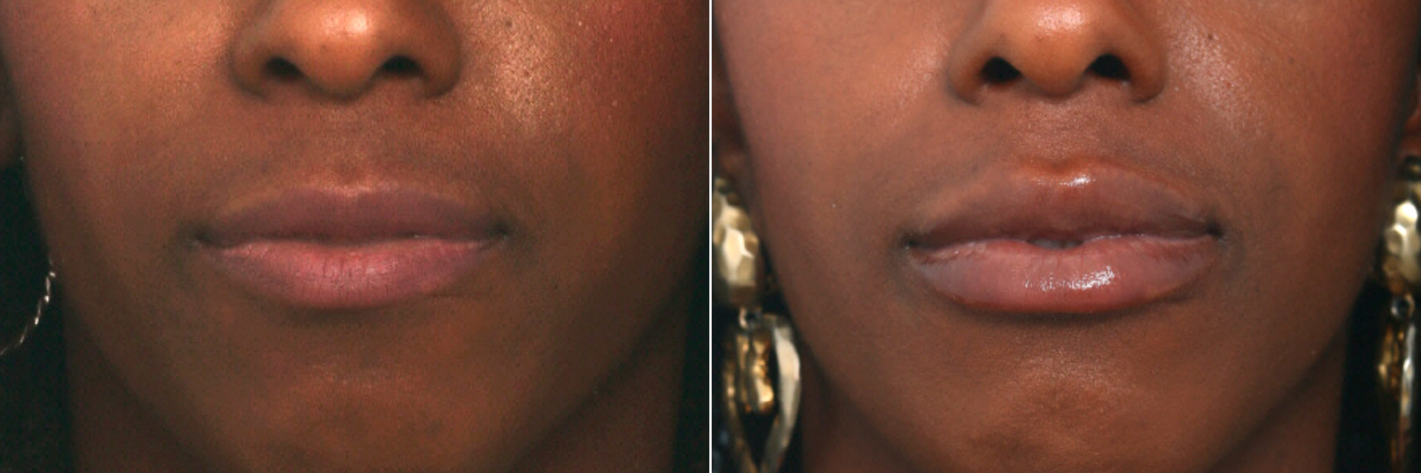 Lip Enhancement Photos Houston, Tx Patient 10093