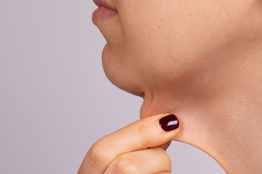 Patient showcasing her excess neck skin in relation to procedures meant to reduce loose neck skin such as dermal fillers, ultrasound energy, and even invasive procedures like mini neck lift and traditional neck lift surgery.