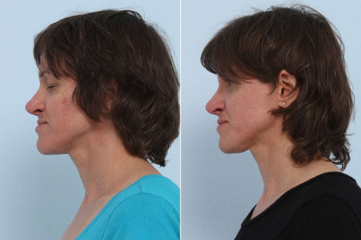 Chemical Peels Before and After Photos in Houston, TX, Patient 10226