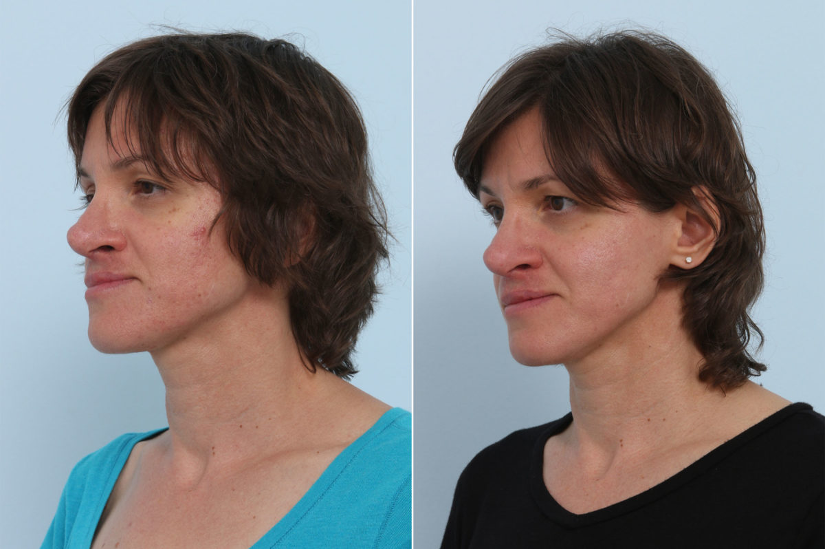 Chemical Peels Before and After Photos in Houston, TX, Patient 10226