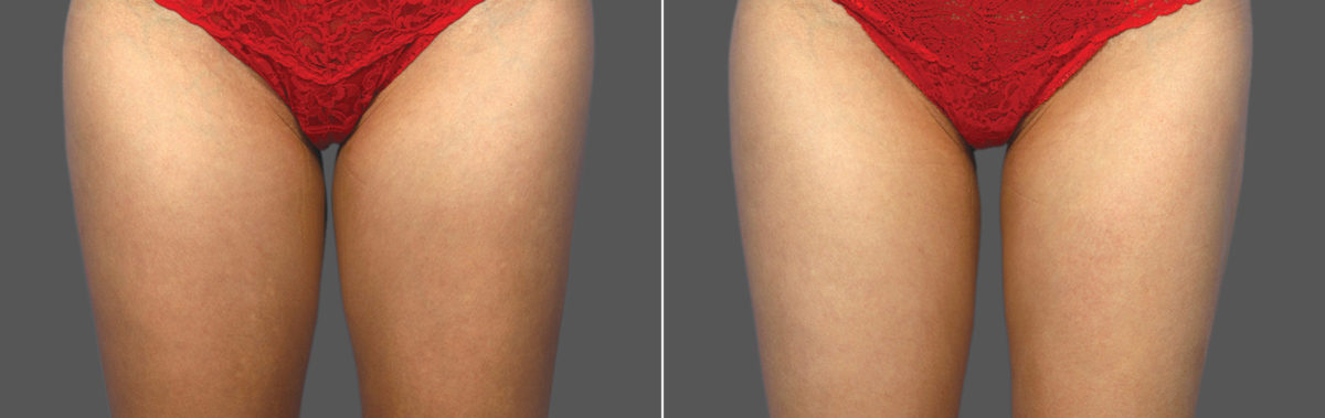 CoolSculpting Before and After Photos in Houston, TX, Patient 10179