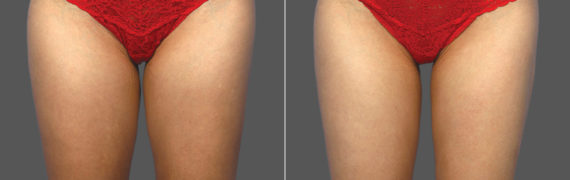 CoolSculpting Before and After Photos in Houston, TX, Patient 10179