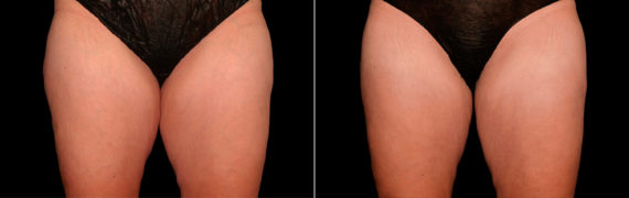 CoolSculpting Before and After Photos in Houston, TX, Patient 10180