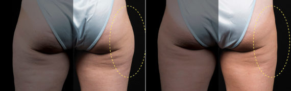 CoolSculpting Before and After Photos in Houston, TX, Patient 10178