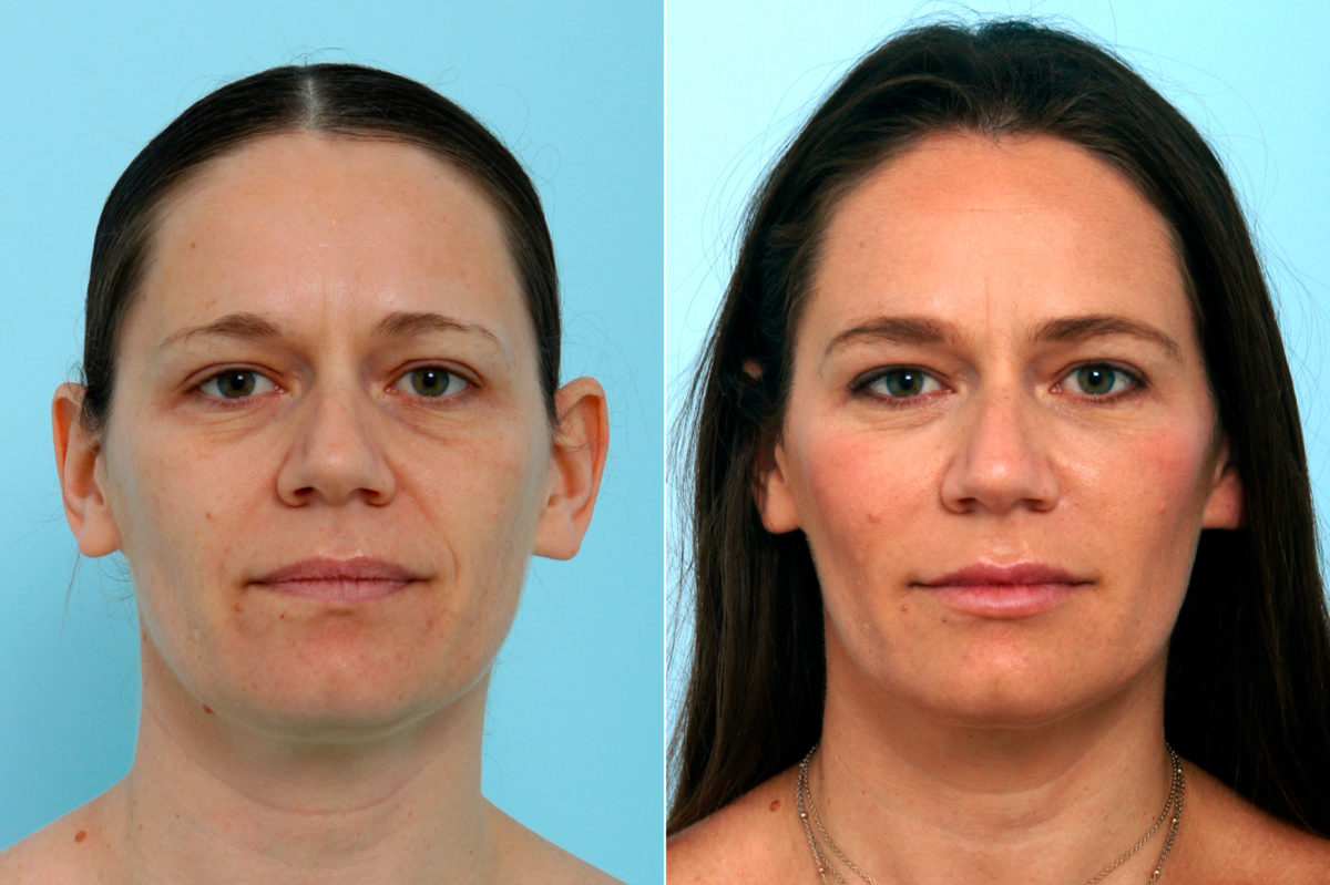 Fillers Before and After Photos in Houston, TX, Patient 10157