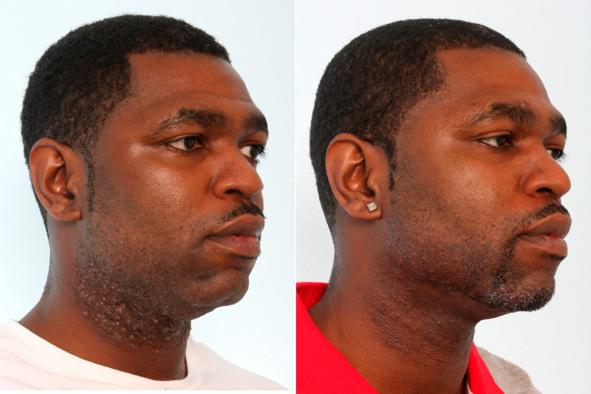 Laser Hair Removal Before and After Photos in Houston, TX, Patient 10171