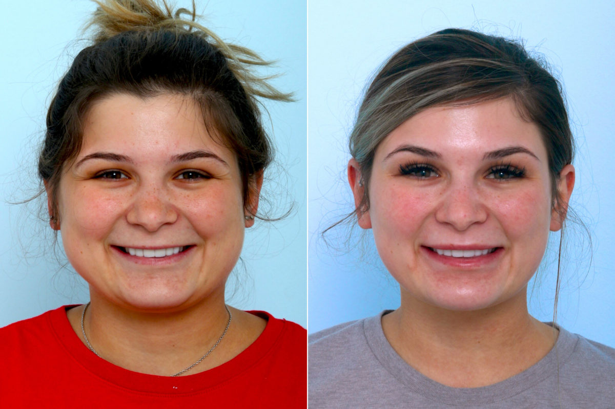 Botox® Cosmetic Before and After Photos in Houston, TX, Patient 10304