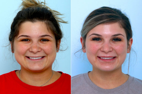 Botox® Cosmetic & Xeomin Before and After Photos in Houston, TX, Patient 10304