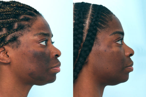 Chemical Peels Before and After Photos in Houston, TX, Patient 10039