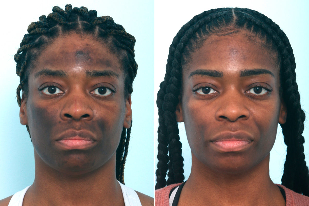Chemical Peels Before and After Photos in Houston, TX, Patient 10039