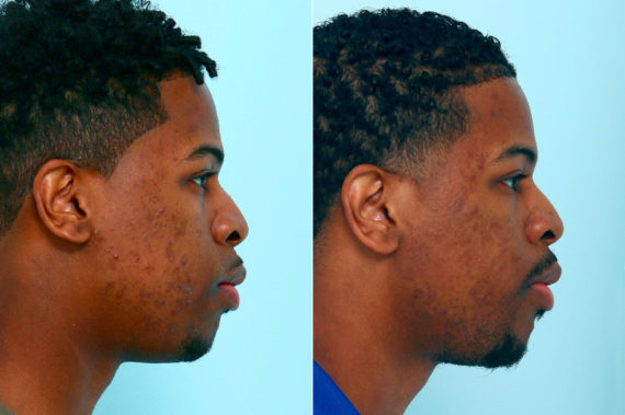 Chemical Peels Before and After Photos in Houston, TX, Patient 10061