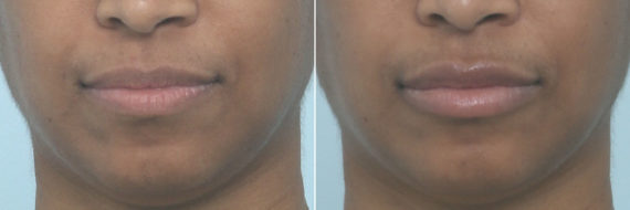 Lip Enhancement Before and After Photos in Houston, TX, Patient 10259