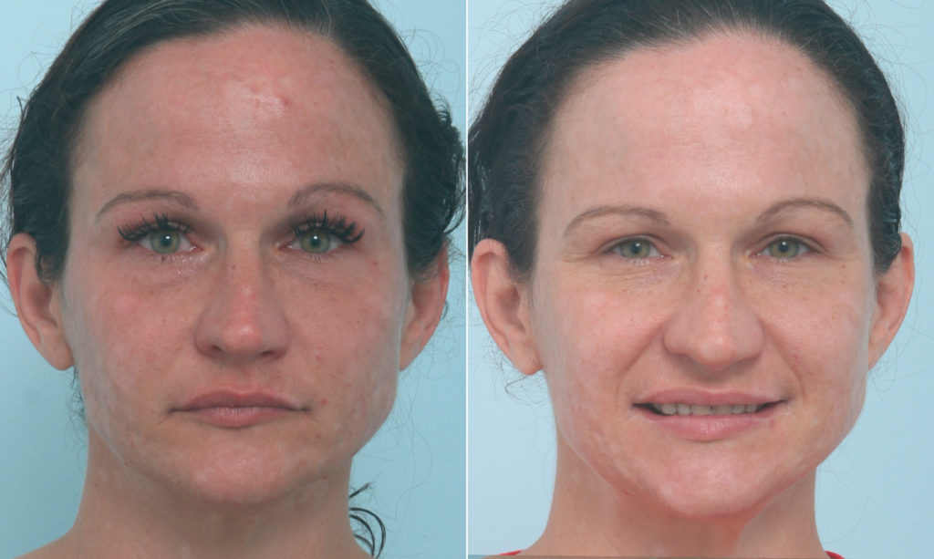 Fraxel Laser Before And After: See The Difference! - 7eio11m