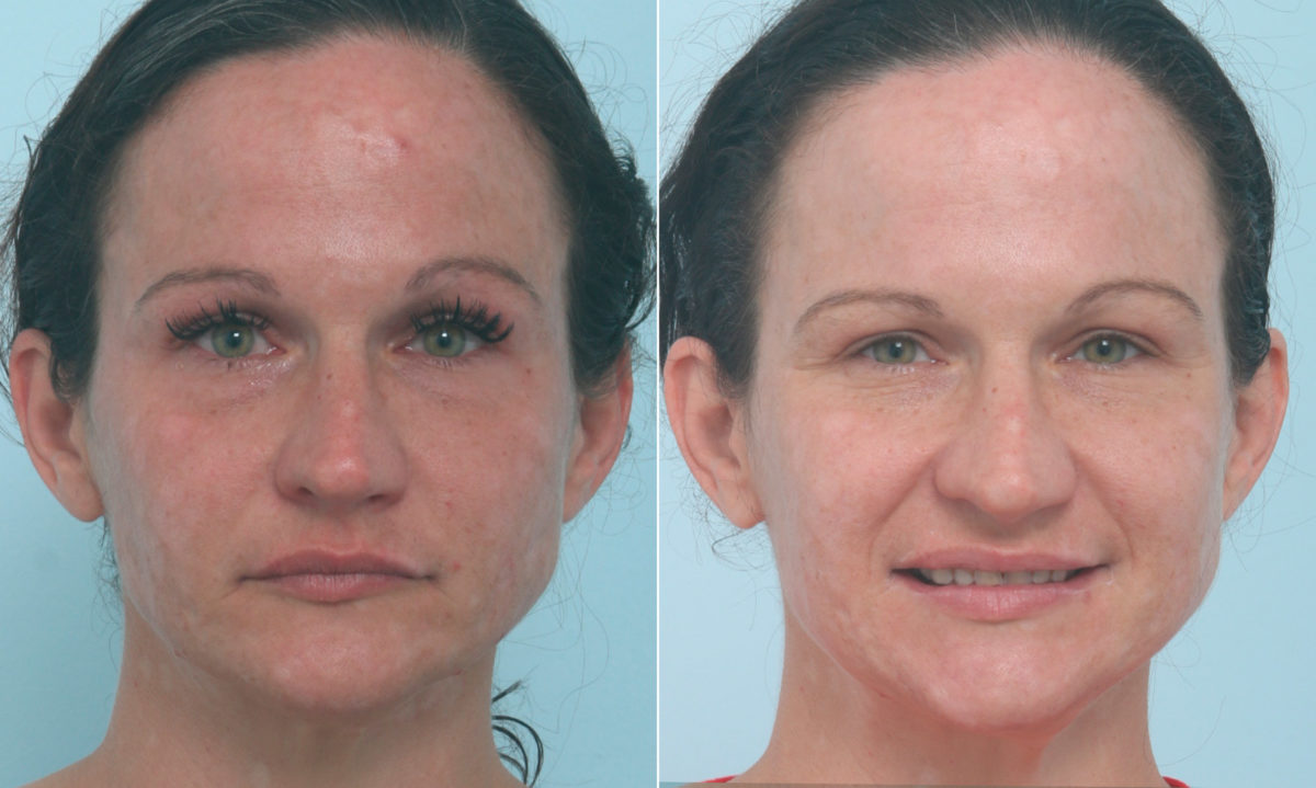 Fraxel Laser Before and After Photos in Houston, TX, Patient 10321