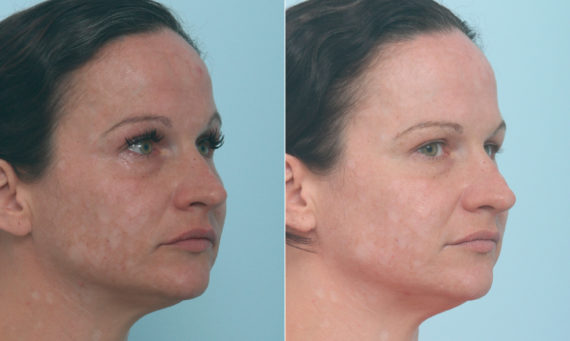 Fraxel Laser Before and After Photos in Houston, TX, Patient 10321