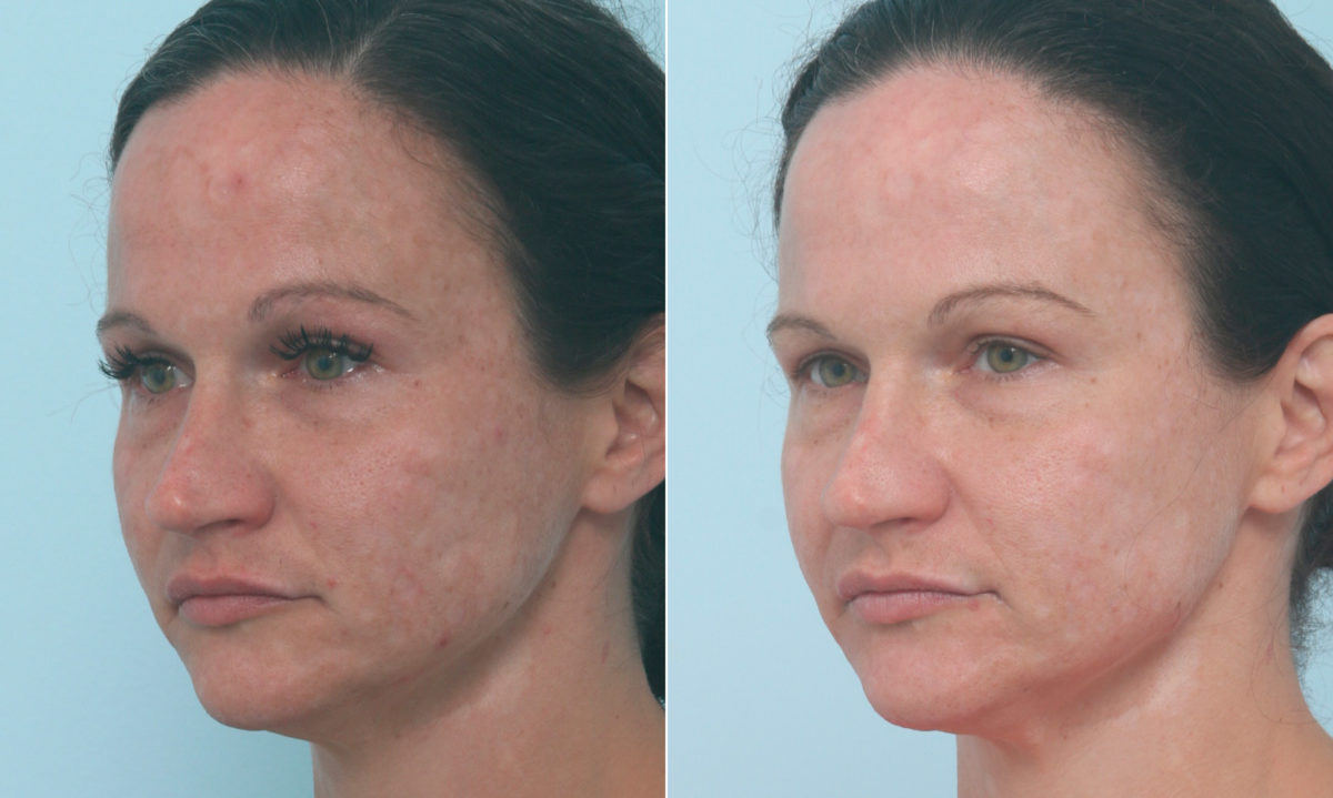 Fraxel Laser Before and After Photos in Houston, TX, Patient 10321