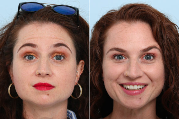 Botox® Cosmetic & Xeomin Before and After Photos in Houston, TX, Patient 10367